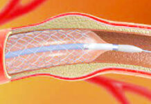 स्टेंट के रेस्टेनोसिस को रोकने में मददगार हैं नई तकनीकें, जाने यहां प्रतीकात्मक फोटो : साभार सोशल मीडिया